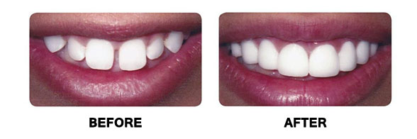 Smile Makeover in Monmouth County NJ