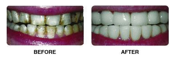 Before and after picture of teeth