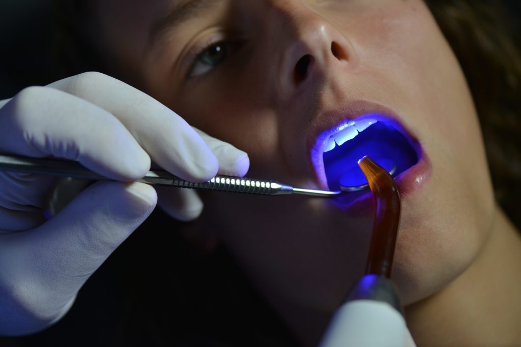 Dentist using curing light for composite in patient's mouth
