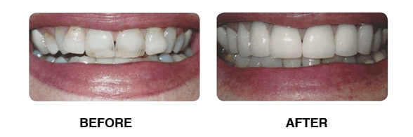Before and after picture of teeth