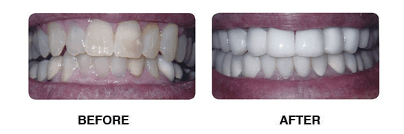 Before and after dental cleaning service in Wall Township, NJ