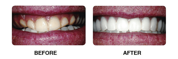 Dental cleaning service before and after treatment in Wall Township, NJ